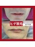 【見た目＆剃刀負け改善】メンズヒゲ脱毛★夏集中コース／効果保証付き！