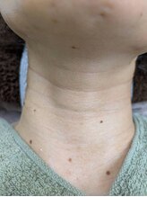 ブルーココア(BlueCocoa)/溶けるコラーゲン糸リフト、首