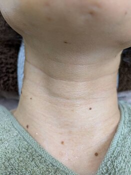 ブルーココア(BlueCocoa)/溶けるコラーゲン糸リフト、首