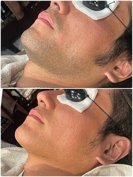 グロー(GLOW)/メンズヒゲ脱毛