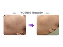 ユアーズ ビューティー(YOURS beauty)/棘あり☆１回