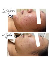 ビズビズ 梅田店(bisebise)/<症例>ニキビケア・跡赤み