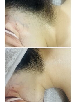 セラス(CERAS)/えりあし脱毛