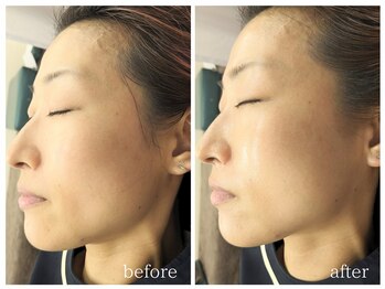 ラミーユ(La Miu)/剥離なしハーブピーリング