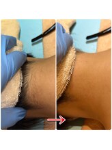 エデン(Eden)/うなじワックスビフォーアフター