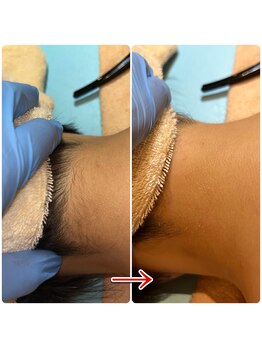 エデン(Eden)/うなじワックスビフォーアフター