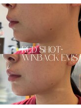 さかうえ接骨院/レッドショット×WINBACK