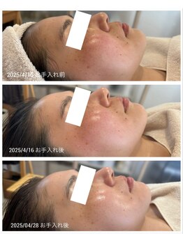 前田さんちのエステサロン ドゥース(douce.)/Before/after