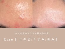 シーヴォーク(Cveauque)/ハーブピーリング｜ハーブリプロ