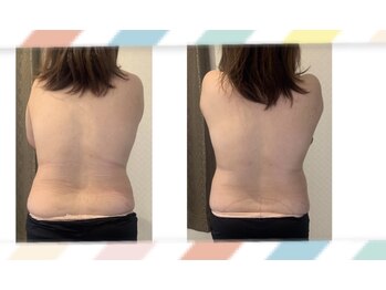 RBD/【熊本/南熊本/脂肪冷却/痩身】