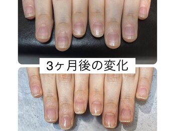 アンドネイル 海老名(&nail)/最強ネイルケア3ヶ月後の変化☆