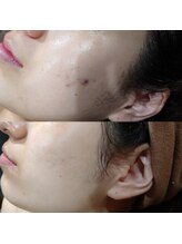 ボーソリューション(Beau-Solution)/【20代　ニキビケア】