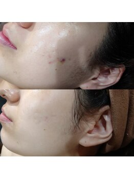 ボーソリューション(Beau-Solution)/【20代　ニキビケア】