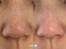 シェリー(cherie)/毛穴洗浄