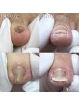 巻き爪補正店 水戸駅前店/【巻き爪補正】