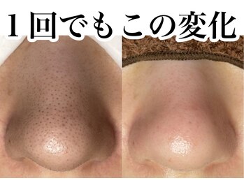 アンドピエル(AndPiel)/毛穴ケア！Before After★