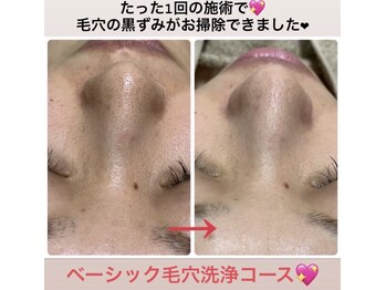 イアリイ/毛穴洗浄エステコース