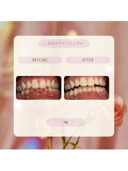 プラスビー 2号店(+b)/ホワイトニングビフォーアフター