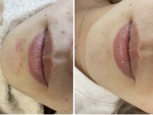 ラヴィ(Ravi)/口周りのニキビケア