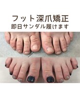 ティアラネイル 宇都宮/深爪矯正
