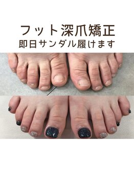 ティアラネイル 宇都宮/深爪矯正