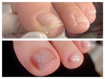 フット巻き爪ケア