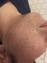 シャルム(CHARME)/メンズ脱毛