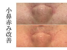 エトレ(etre)/毛穴/ニキビケア/フェイシャル