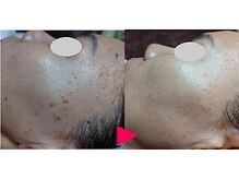 アイビューティーセンターの雰囲気(シミケアで、嬉しいお肌に変わります!カウンセリング無料です。)