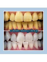 ホワイトニングショップ 堺東店/【ビフォーアフター】10回