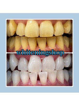 ホワイトニングショップ 堺東店/【ビフォーアフター】10回