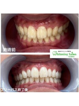 ホワイトニングサロン 名古屋駅店/【ホワイトニング施術例】