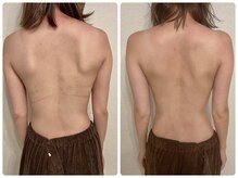 プリマ(prima)/バストアップ施術症例