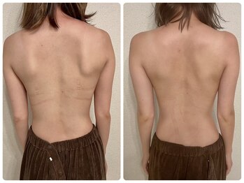 プリマ(prima)/バストアップ施術症例