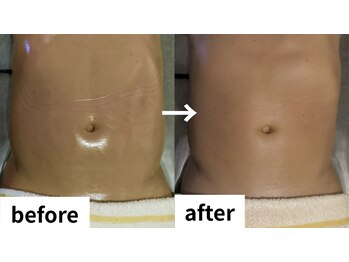 ゼロミリメートル(0mm)/【インディバ】ビフォーアフター