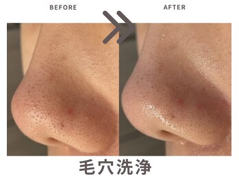 エステティックサロン ラ ベルタ(Esthetic Salon La Belta)/毛穴洗浄
