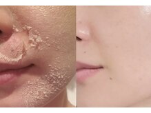 エヌ スタイル(N Style)/リベルハーブピーリング 