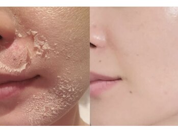 エヌ スタイル(N Style)/リベルハーブピーリング 