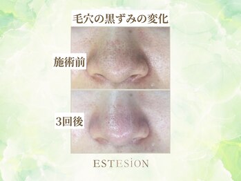 エステシオン(ESTESiON)/毛穴汚れの変化