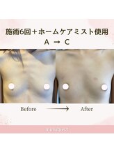 ミミバスト(mimibust)/バストアップBeforeAfter