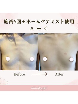ミミバスト(mimibust)/バストアップBeforeAfter