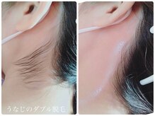 サロン ド モア(salon de MORE)/うなじのダブル脱毛