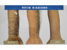 クローバー(clover)/腕脱毛