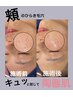 【7月☆美白ケア】ダウンタイム無・ハーブピーリング　3回¥59,400→￥33,000