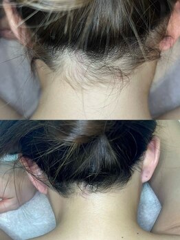 マナ(mana)/うなじ脱毛