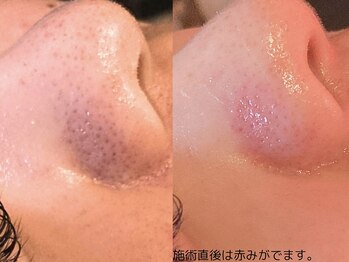 ミエリア美容鍼灸院(mielia美容鍼灸院)/毛穴洗浄スクラバー(ノーマル)