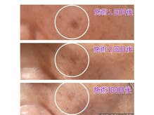 サロン ド ネイジュ(Salon de Neije)の雰囲気(シミケア施術の途中経過)