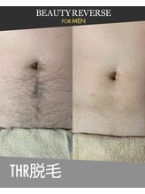 ビューティーリバース 東戸塚店/メンズ胸脱毛　THR方式脱毛