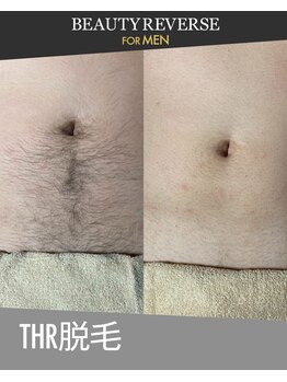 ビューティーリバース 東戸塚店/メンズ胸脱毛　THR方式脱毛