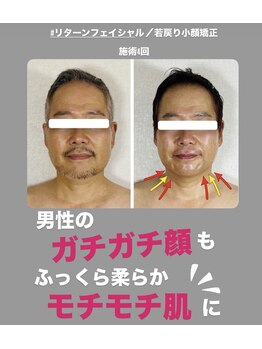 真美(Sinbi)/リターンフェイシャル/施術3回